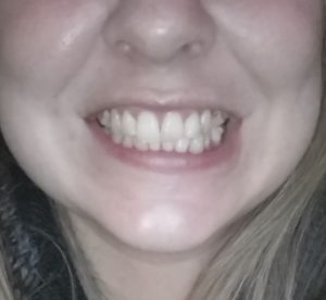 My teeth - Invisalign journey