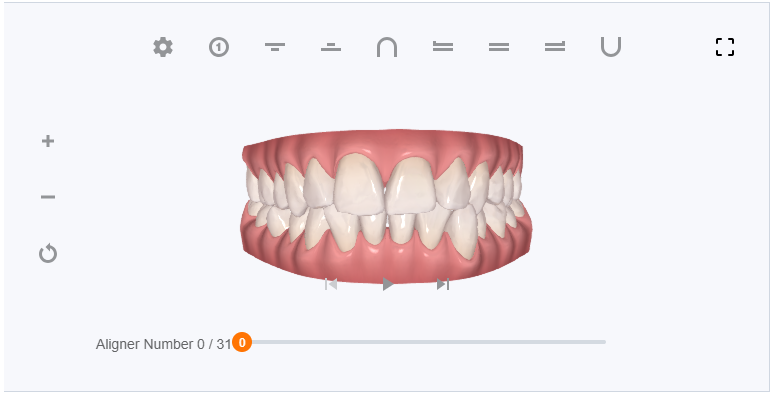 My Clincheck shown without attachements - aligner 0/31 (before starting)
