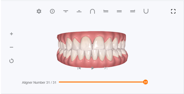 My Clincheck shown without attachements - aligner 31/31 (end result)