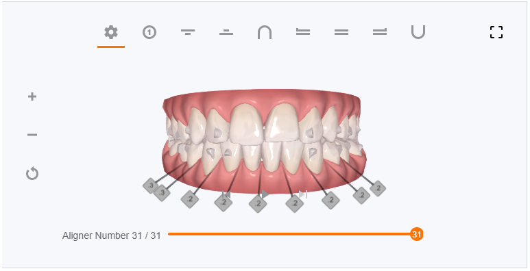 My Clincheck - with attachements - aligner 31/31 (end result)