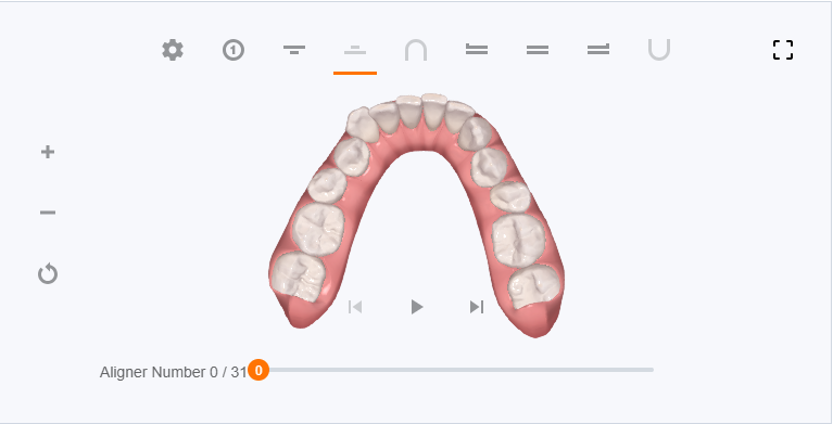 My Clincheck simulation for my lower teeth at the start of treatment