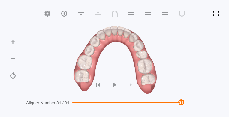 My Clincheck simulation for my lower teeth after 31 aligners (at the end of treatment)