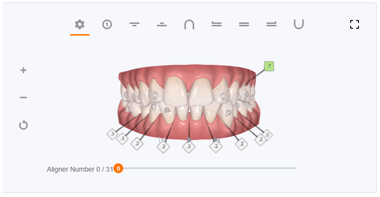 My Clincheck - with attachements - aligner 0/31 (before starting)